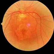 Degeneración macular