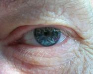 degeneracion-macular