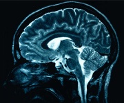 parkinson