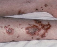 meningitis1