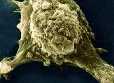 cáncer