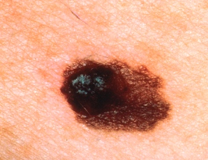 melanoma