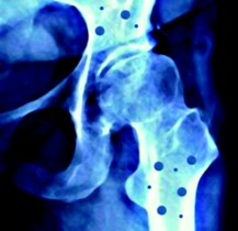 osteoporosis