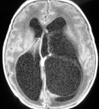hidrocefalia