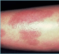psoriasis