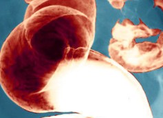 cancer colon