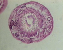 hidatidosis