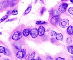 carcinoma-papilar