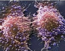 cáncer de prostata