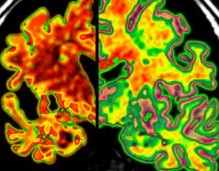 Alzheimer