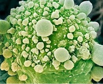 cáncer de pancreas