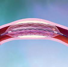 angioplastia coronaria