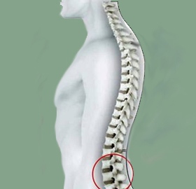 lumbalgia
