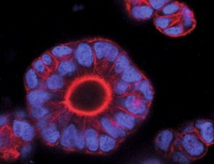 cancer colon 1