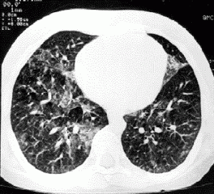 fibrosis idio