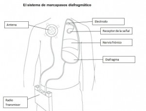 marcapasos grafico