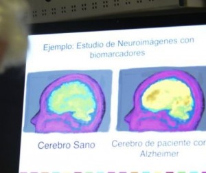 alzheimer_cura_ultrasonido_624x351_getty