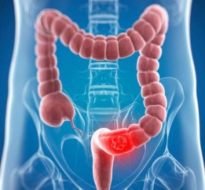 cancer-colorrectal-4to-1935662