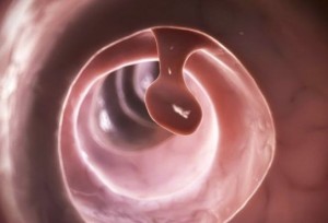 polipo_cancer_624x351_thinkstock