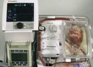 transplante_corazon_624x351_transmedics