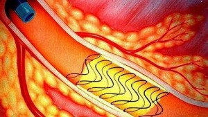 ictus-stent--478x270