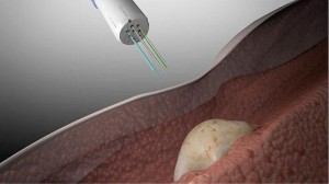 tecnicas tumor