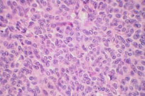 cancer ovario