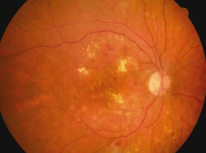 edema macular