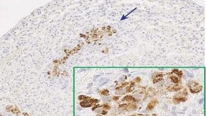 mestastasis--620x349
