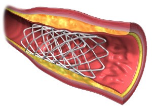 stent