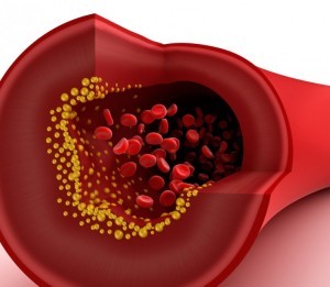 ateroesclerosis