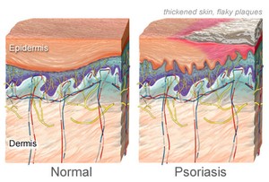 psoriasis-3