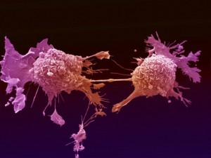 melanoma