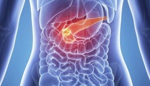 pancreatic-cancer1-300x172