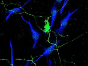 satelitosisperineural-knPG--620x349@abc