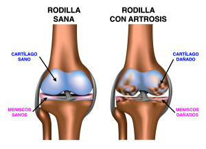 Artrosisrodilla