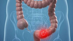 cancer colon