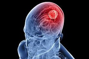 tumor-cerebral