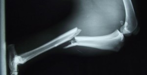 fractura