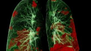 pulmones
