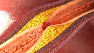 16/02/2018 Aterosclerosis, ateroma, arteria obstruida. El músculo del corazón recibe la sangre a través de las arterias coronarias, lo que le permite nutrirse de oxígeno y de otros componentes necesarios para su funcionamiento. No obstante, estas arterias pueden enfermar y la primera causa de ello es la aterosclerosis. ESPAÑA EUROPA MADRID SALUD GETTY IMAGES/ISTOCKPHOTO / 7ACTIVESTUDIO