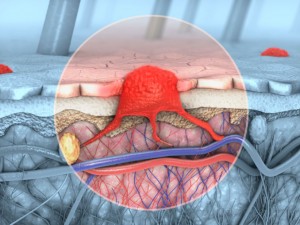 melanoma