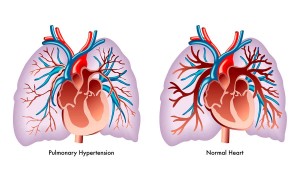 hipertension-pulmonar