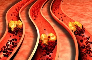 aterosclerosis