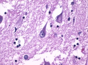 Nueva-diana-terapeutica-en-el-inicio-de-la-cascada-bioquimica-que-origina-el-alzheimer