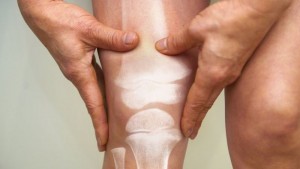 osteoporosis