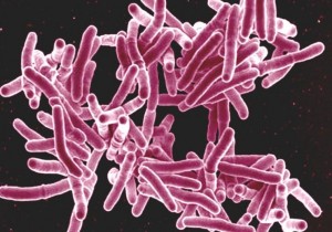 tuberculosis-RO