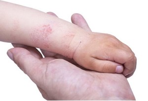 Eczema on the skin of the kid's hand Eczema manos bebés dermatitis niños
