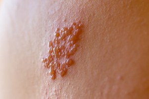 herpes zoster