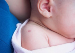 vaccination reaction of Bacillus Calmette Guerin BCG vaccine on newborn baby shoulder, used against tuberculosis